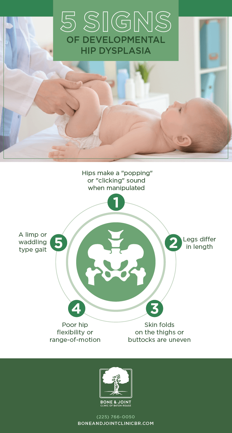 Signs of hip 2025 dysplasia in babies